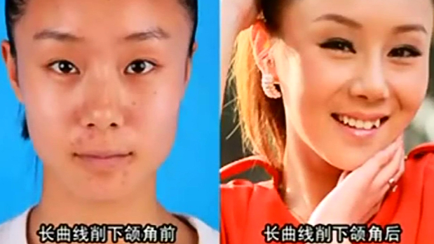 韩国长曲线削下颌角瘦脸