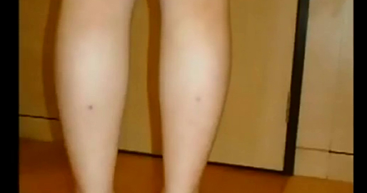 雷射溶脂瘦小腿