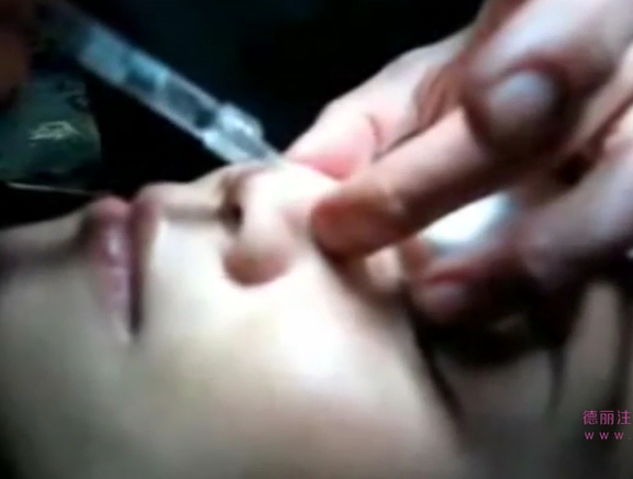 专家现场演示玻尿酸隆鼻