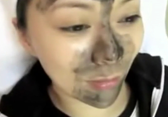 碳粉激光去毛孔