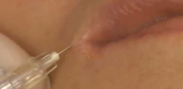 玻尿酸注射丰唇过程