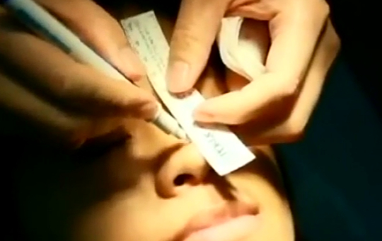 玻尿酸鼻部塑型-自然度