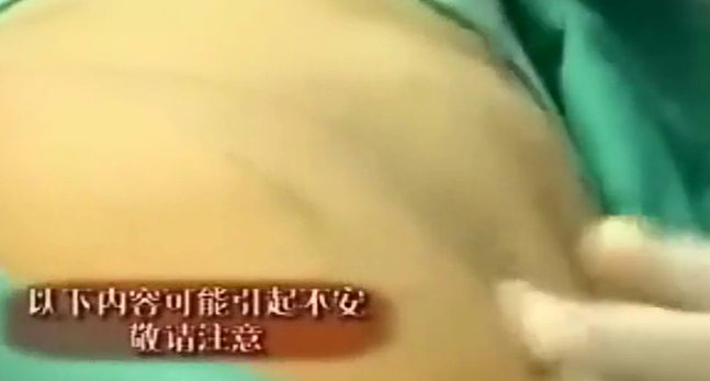 自体脂肪移植抽脂