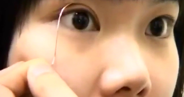 外科整形手术变双眼皮