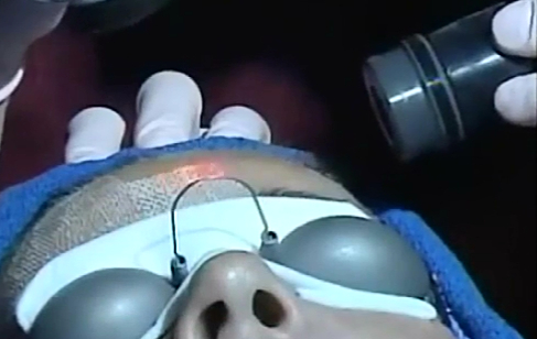 激光嫩肤 换更好更健康的皮肤