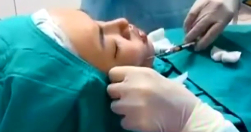 摆脱凹凹脸-自体脂肪丰颊