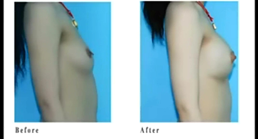 注射自体脂肪丰胸好吗