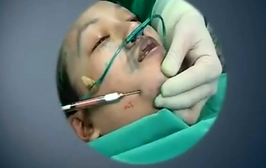 精微自体脂肪移植