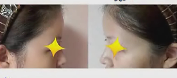 爱贝芙额头整形手术