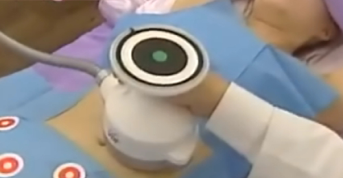 曲线雕塑局部肥 不须在挨针开刀