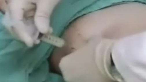 台北美丽之旅溶脂针