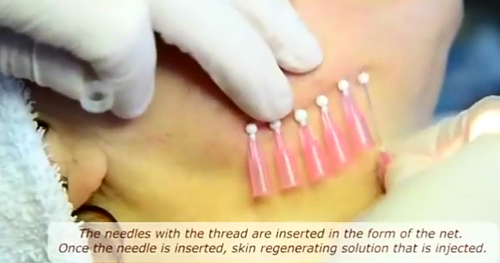 微整形技术培训螺纹升降4D