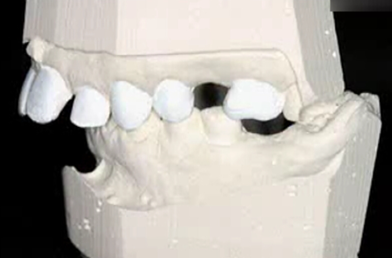 国外种植牙