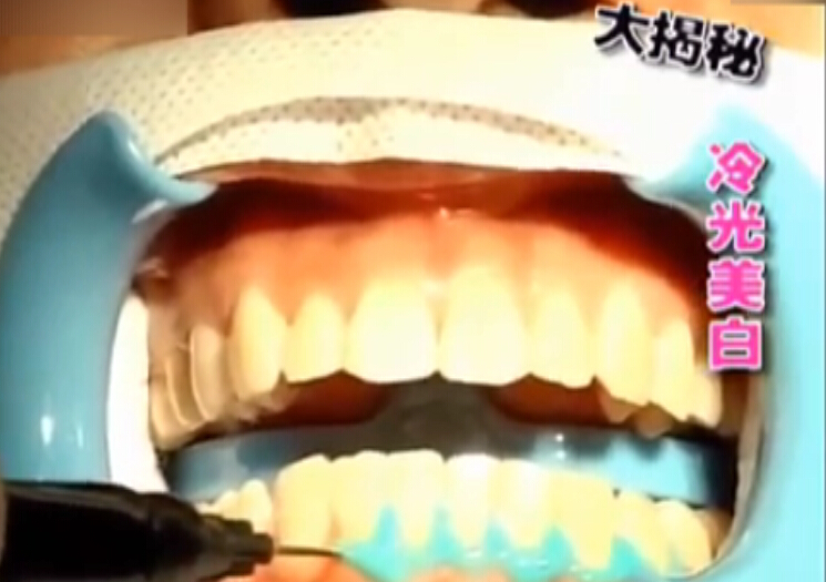 揭秘冷光美白牙齿