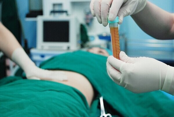 自体脂肪隆胸的必须了解的事