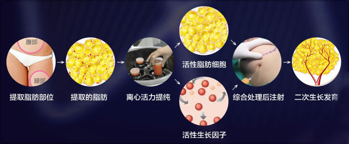 自体脂肪隆胸的几点优势