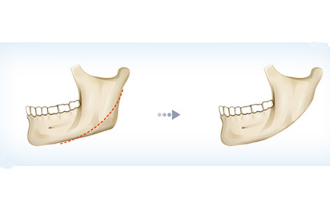 下颌角不对称的几点主要原因