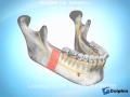 戽斗的正颚手术—下颚升枝矢状截骨术