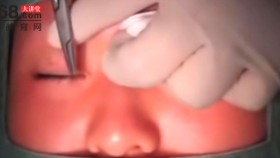 二重埋线法双眼皮手术