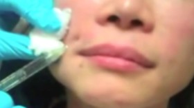 微整形教主玻尿酸