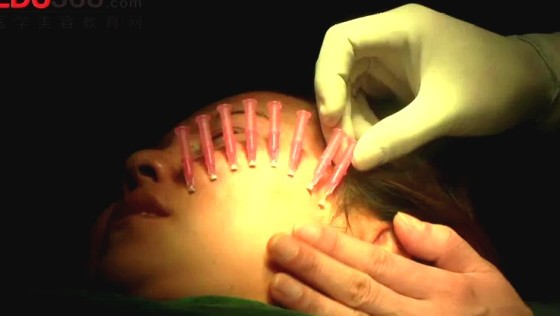 面部埋线提升术