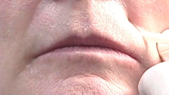 玻尿酸注射面部除皱术