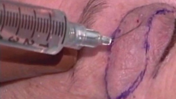 上睑下垂矫正(下)