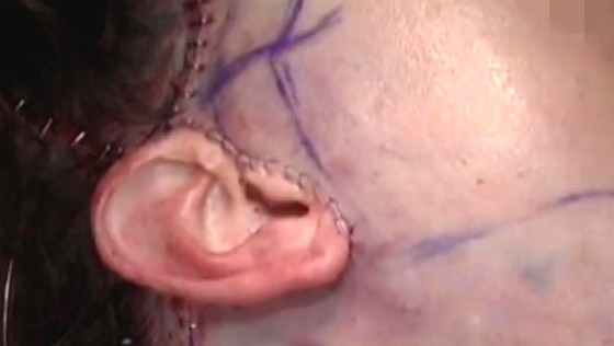 耳前切口面部除皱术