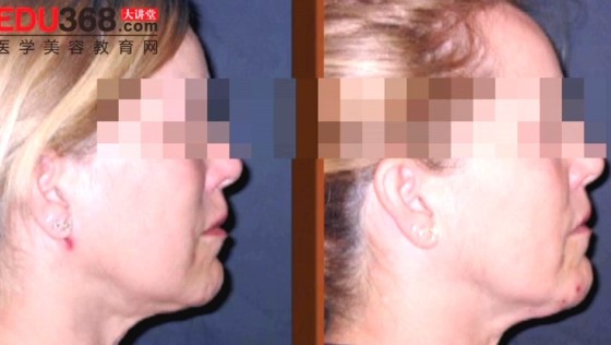 颞部切口杯状线面部年轻化(下)
