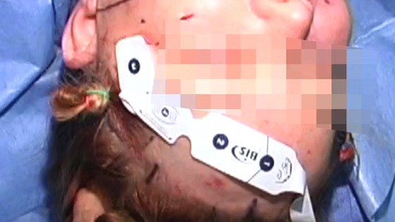 颞部切口杯状线面部年轻化