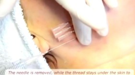 螺纹升降4D埋线提升术