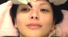 玻尿酸隆鼻过程全记录