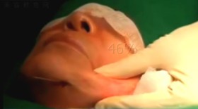 镭射溶脂下巴减肥