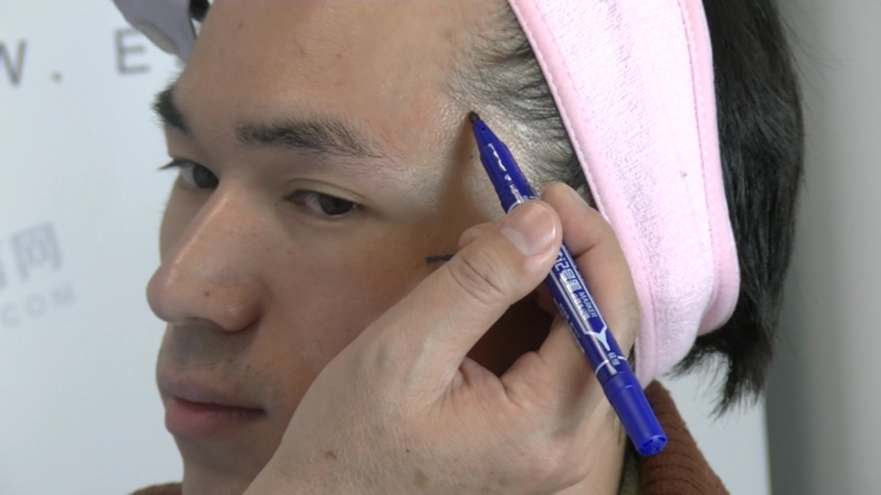 注射玻尿酸丰颞画点