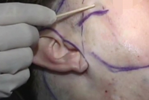 耳前切口面中部除皱