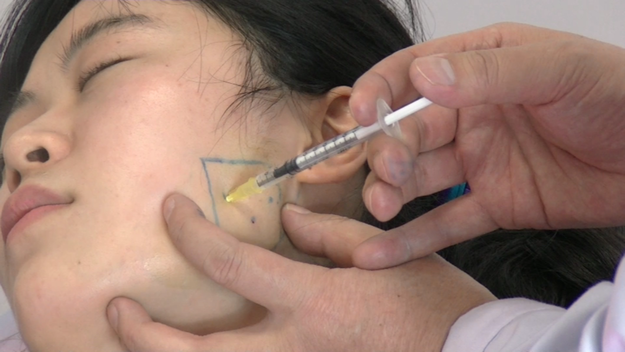 【实操】肉毒素瘦脸针是运用药物阻断神经与肌