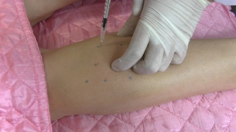 注射肉毒素瘦小腿