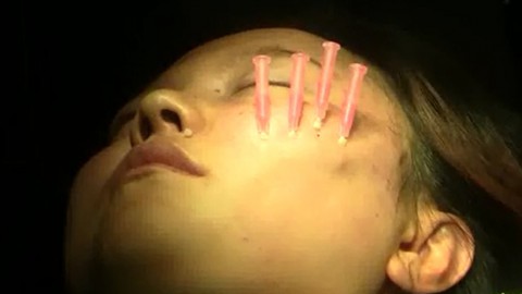 面部埋线紧致提升