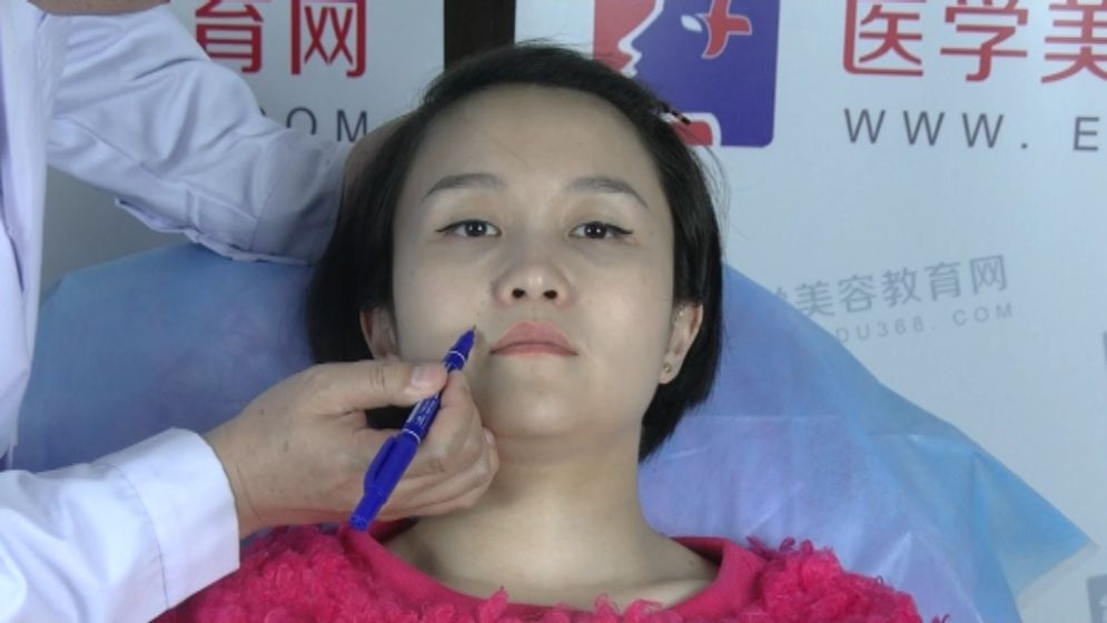 玻尿酸丰鼻唇沟