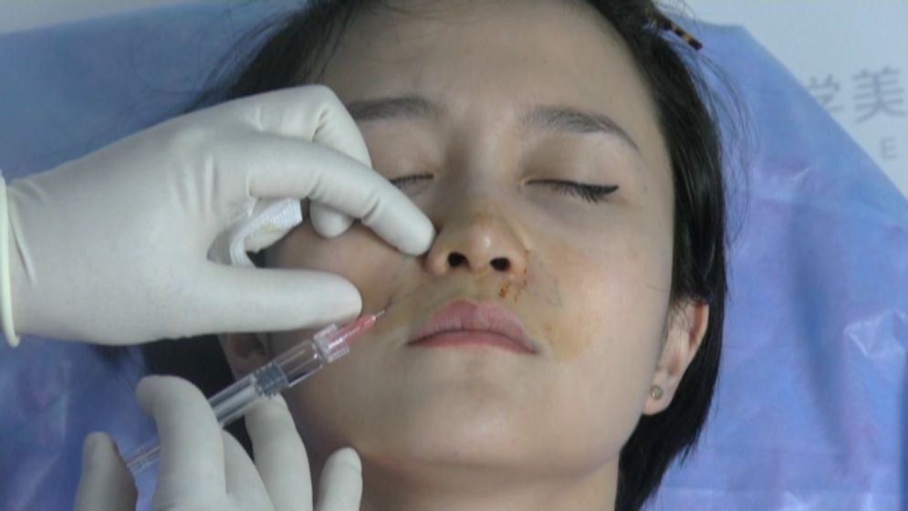 注射填充鼻唇沟