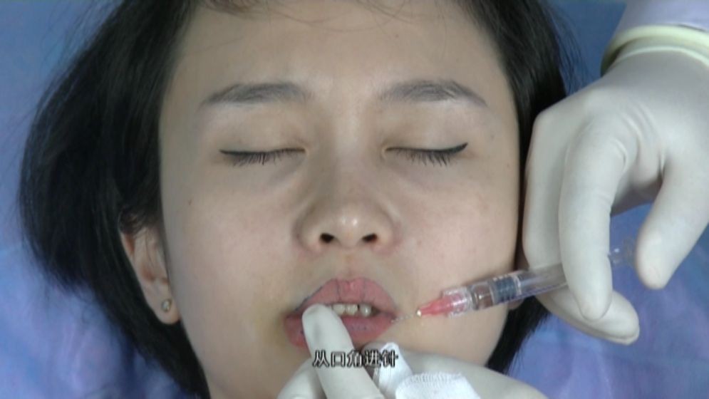 注射玻尿酸丰唇