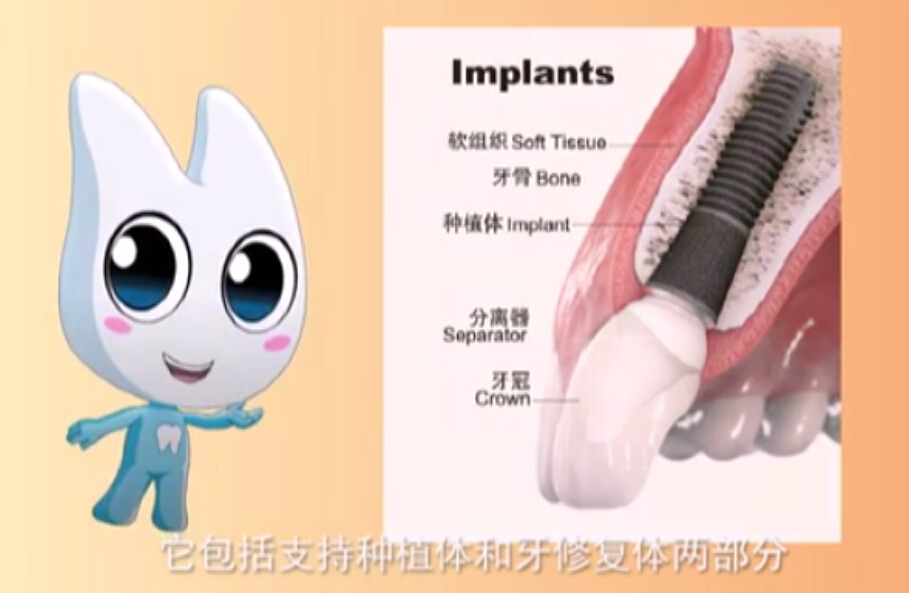 神奇的种植牙