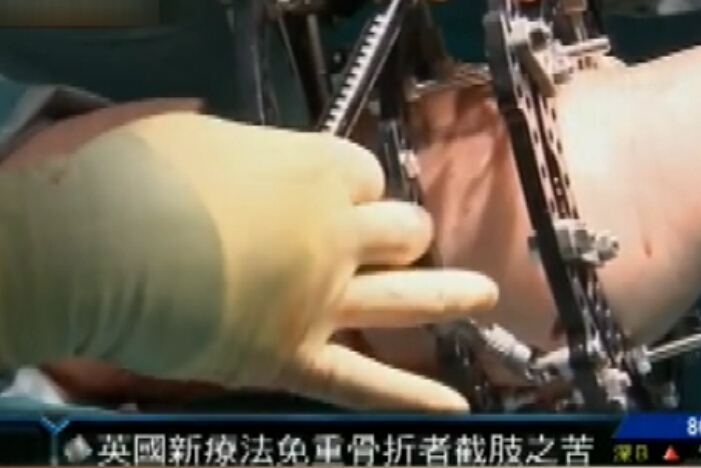 英国干细胞疗法免除重病骨折病人截肢之苦