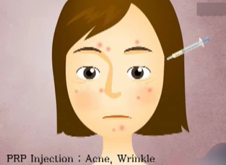 PRP美容技术