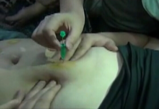 针灸美容手法操作