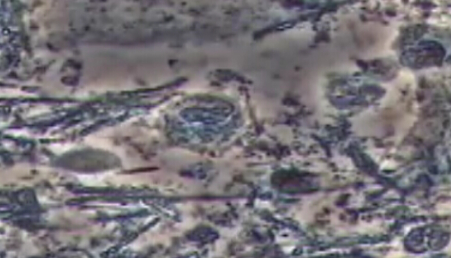 口腔毛滴虫原虫的牙周病治疗