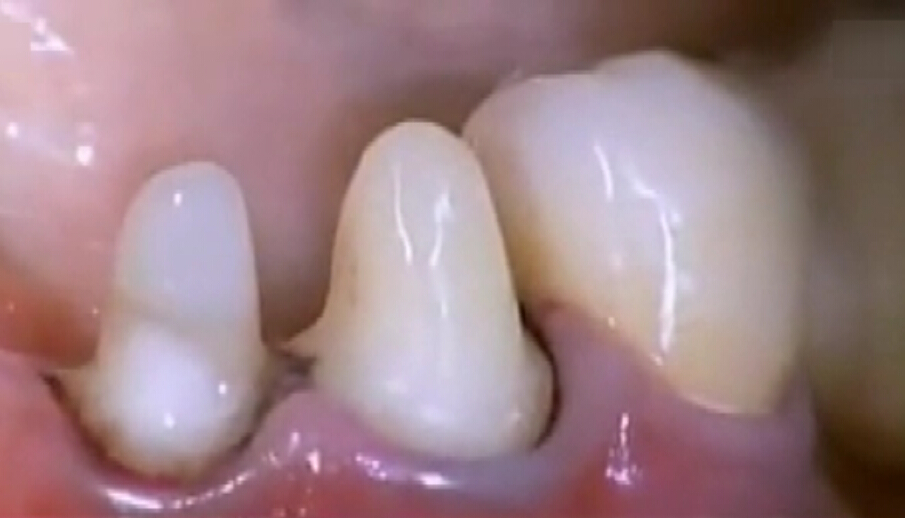 门牙烤瓷牙