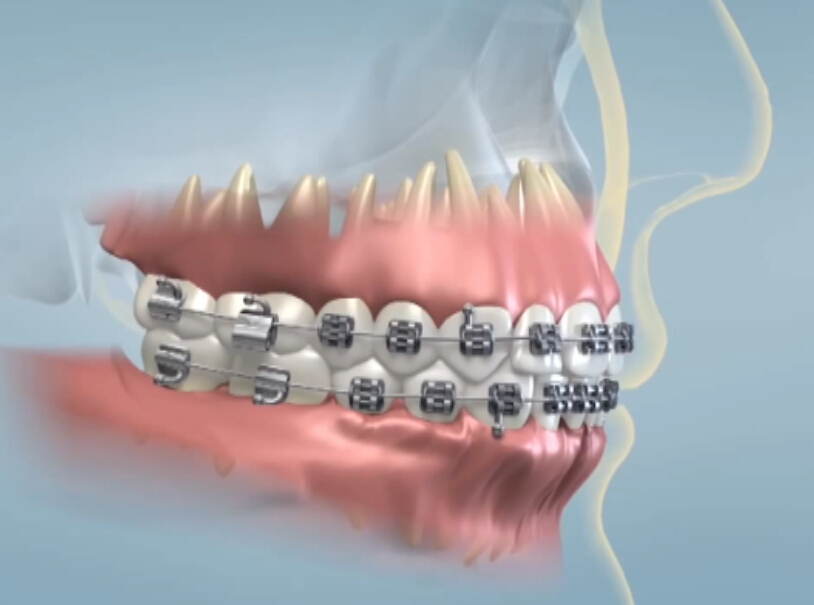 阻生齿与曝光揭对于正畸