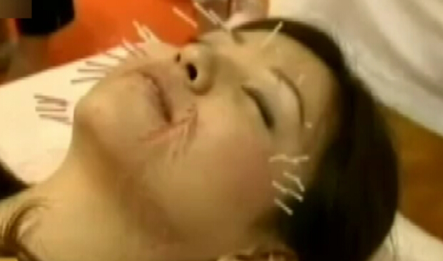 日本流行针灸美容