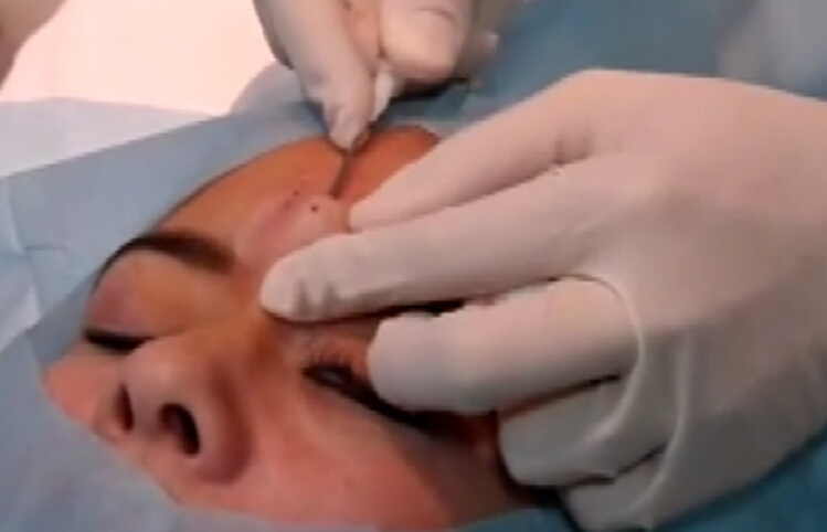 全面部除皱提升及填充